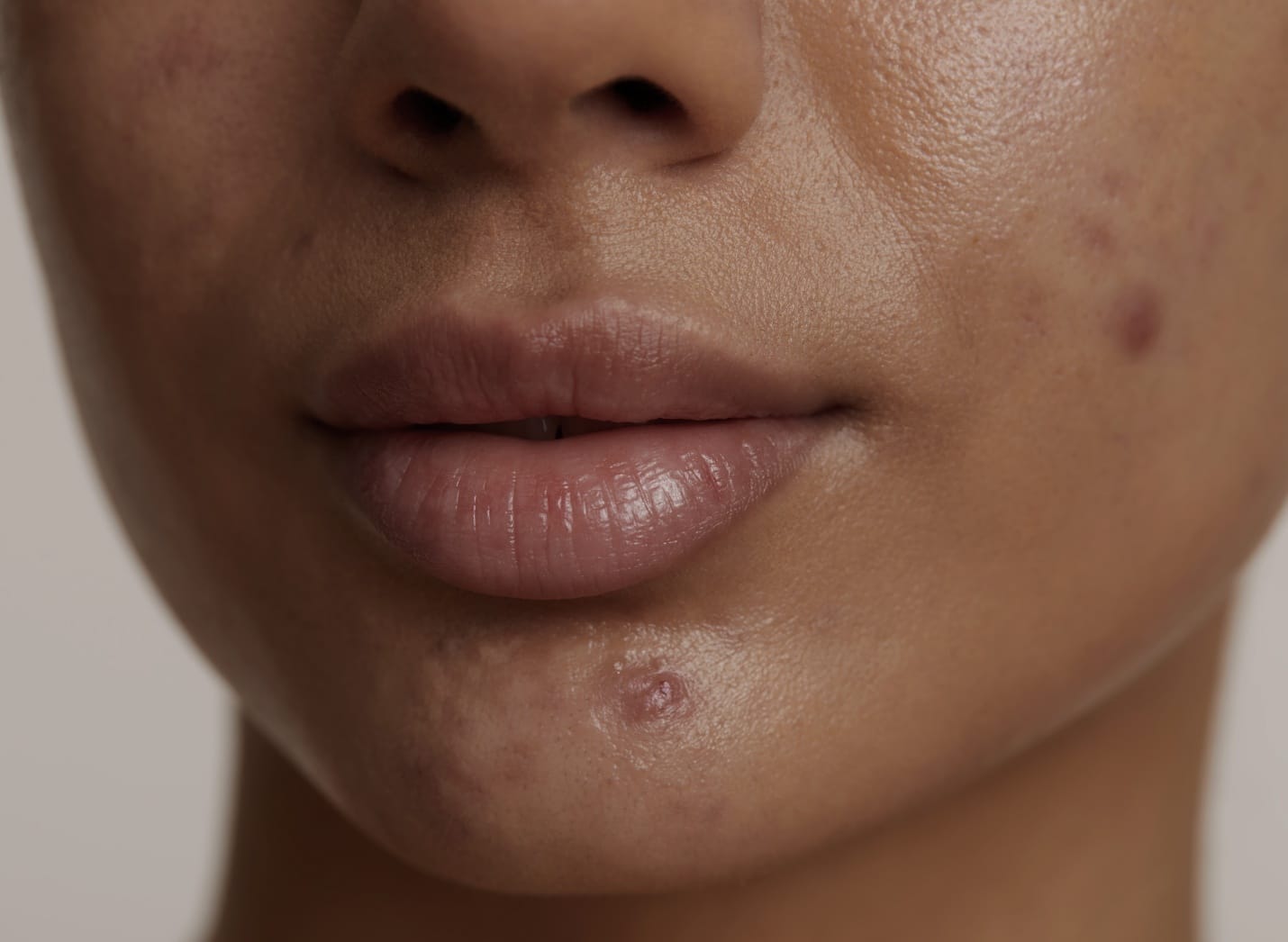 Photo rapprochee de la bouche et menton d une femme qui a l acne traitement acne | Maison abeille esthetique Paris